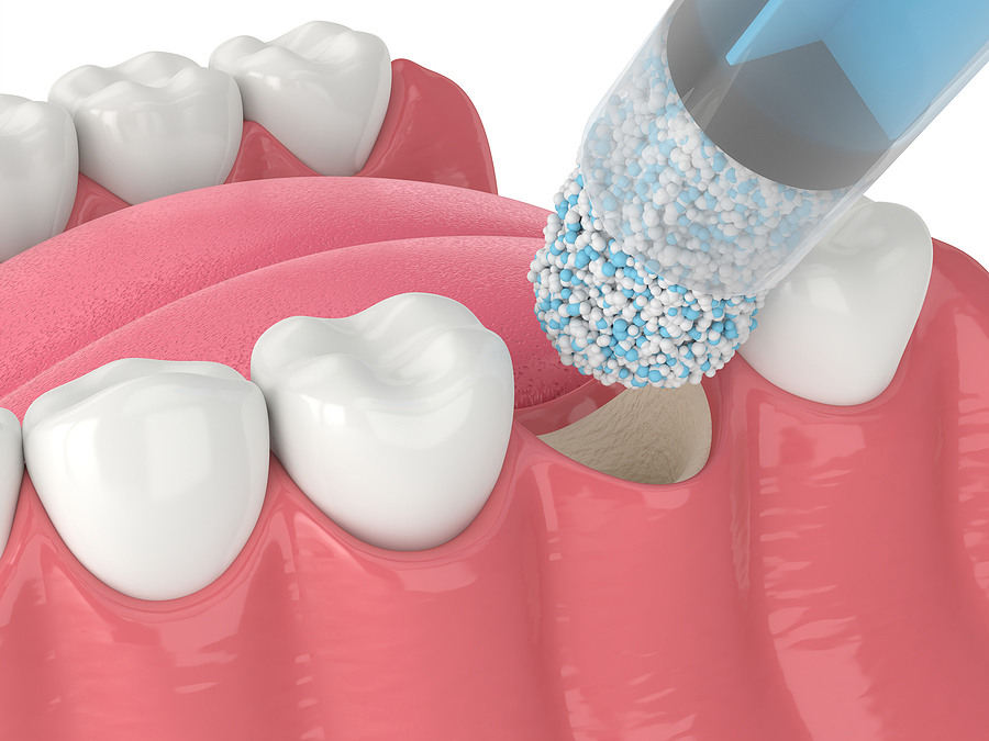 Bone Grafting Bone Grafting